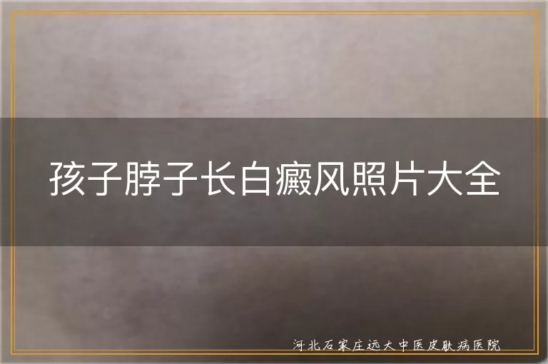 孩子脖子长白癜风照片大全
