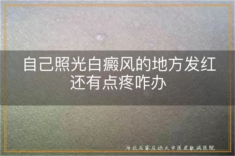 自己照光白癜风的地方发红还有点疼咋办