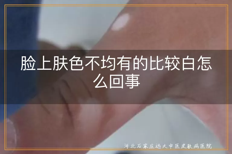 脸上白斑为何更白,脸颊肤色不均白癜风,色斑白块警惕白斑