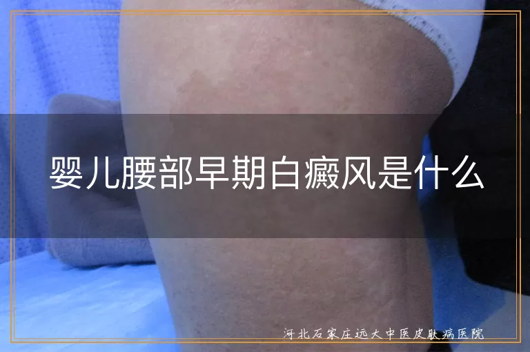 婴幼儿腰部早期白斑症状,婴儿白癜风初期是啥样,新生儿腰侧白斑与白癜风