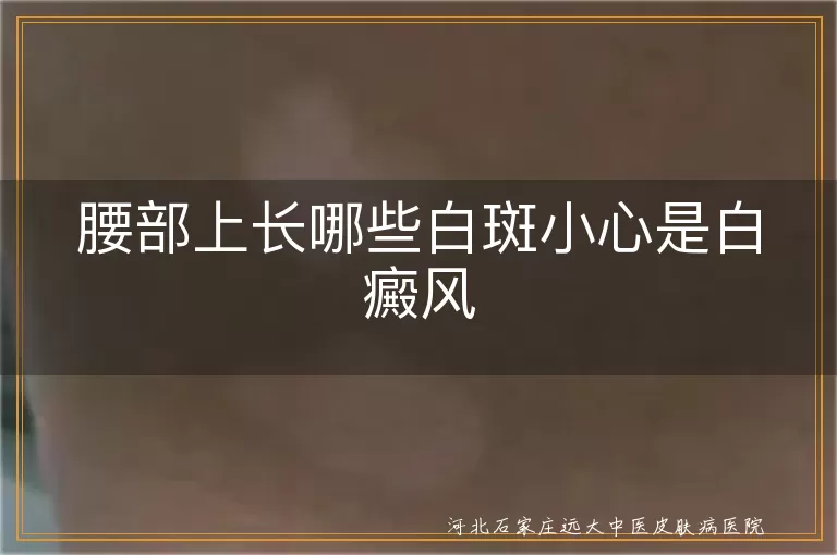 腰部上长哪些白斑小心是白癜风