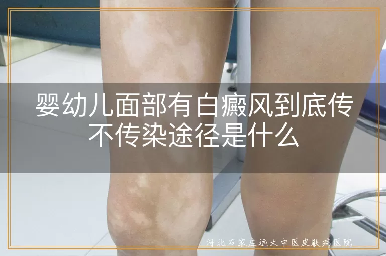 婴幼儿白癜风是否具有传染性揭秘,面部白斑传染风险与预防措施,宝宝白癜风白斑会不会人传人