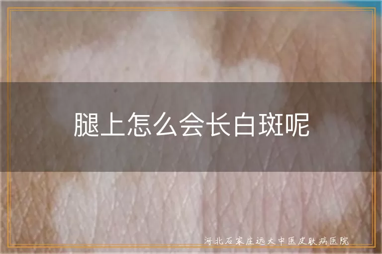 腿上白斑真相与白癜风,小腿白斑不全是白癜风,早期白癜风腿部白斑特征