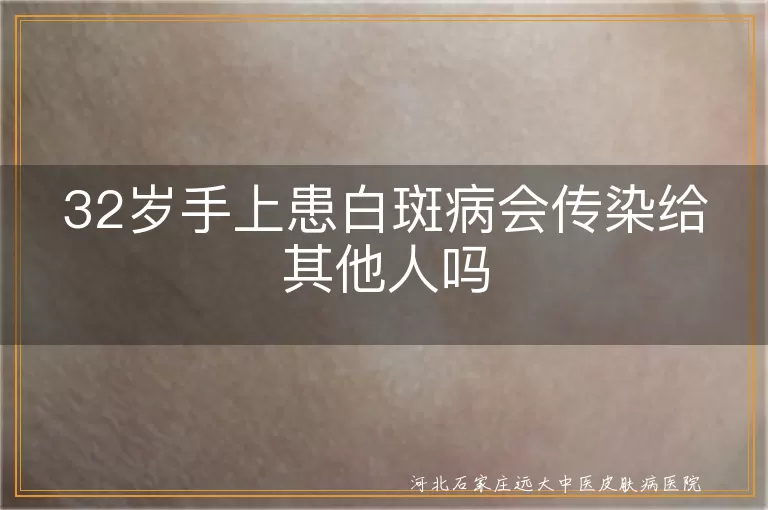 白斑会不会通过握手传染,白癜风日常接触会不会传播,32岁手部白斑遗传还是传染
