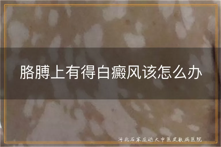 胳膊上有得白癜风该怎么办
