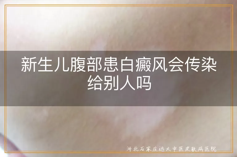 白斑不会传染真相揭秘,白癜风宝宝防护要点,新生儿白斑疑问全解析
