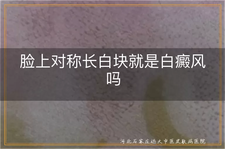 脸上白斑究竟是不是白癜风,面部两侧长白块警惕白癜风,对称性白斑先别慌先看白癜风