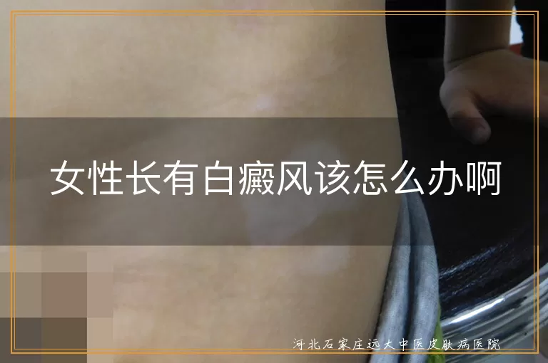 女性脸上出现白斑怎么办,白癜风初期护理技巧,白领女生控制白斑扩散