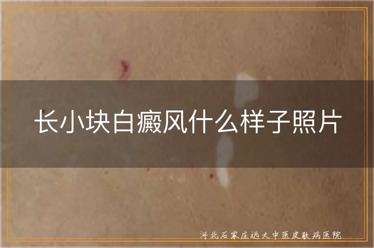 早期小块白癜风实况分享,小块白斑初期表现照片,小白点白癜风长啥样