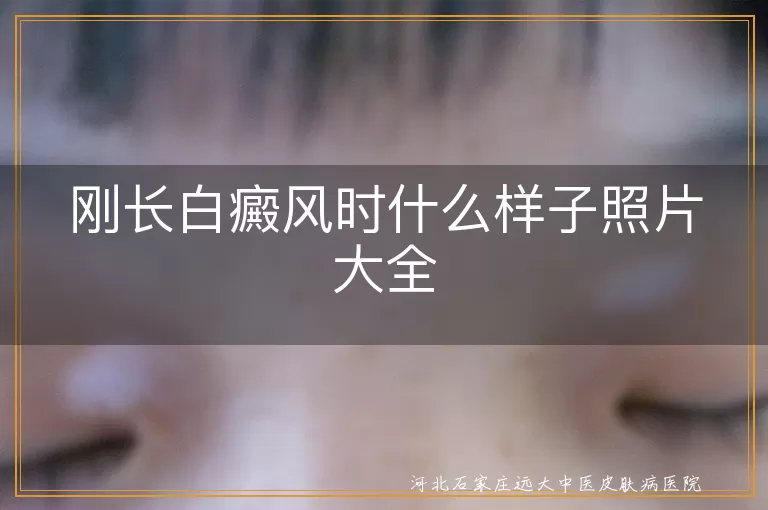 早期白癜风像什么样,白斑初现图片集汇总,新生白癜风形态参考