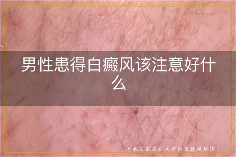 白癜风男性要注意,白斑男士自我护理,男士白癜风生活调护