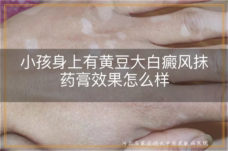 小孩身上有黄豆大白癜风抹药膏效果怎么样