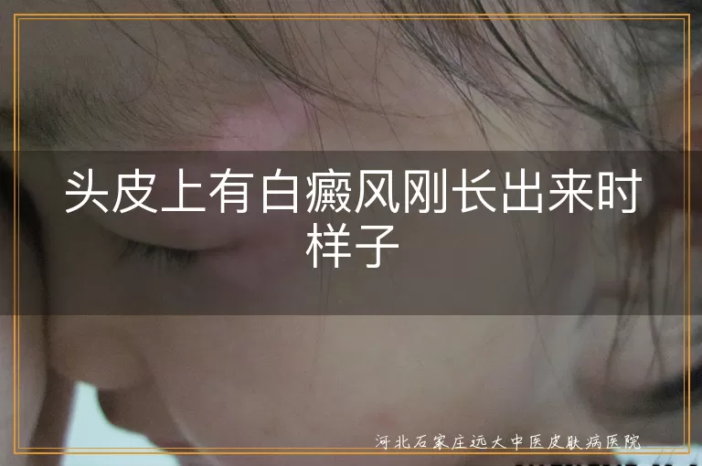白癜风头皮初现特征,白斑早期头皮表现,白癜风头皮初期症状