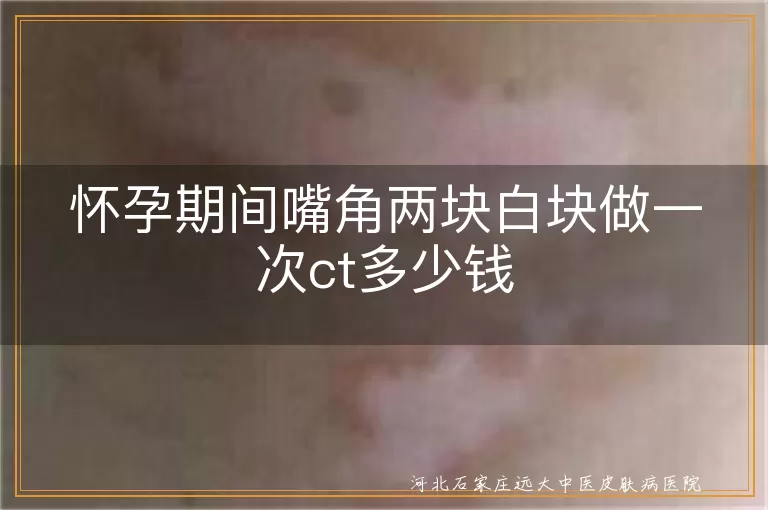 孕期嘴角白斑做一次ct多少钱,嘴角白癜风ct检查要多少钱,妊娠期嘴角两块白斑ct检查费用
