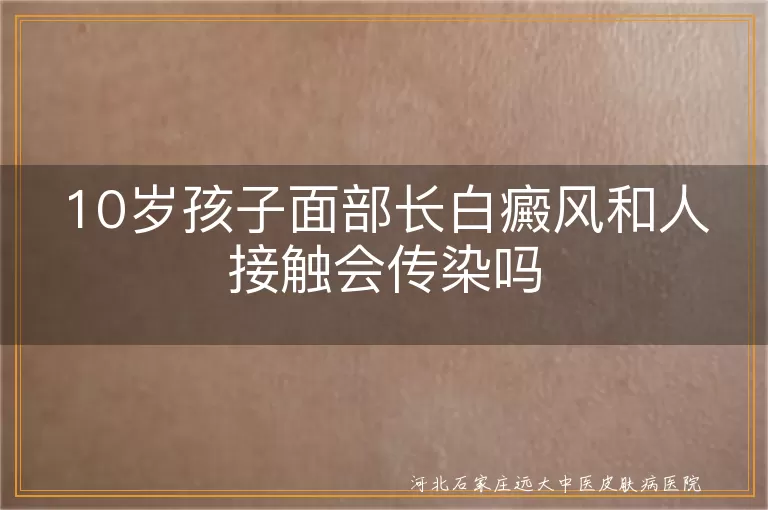 10岁孩子白癜风传染性探究,面部白斑会不会传给别人,儿童白癜风社交疑问