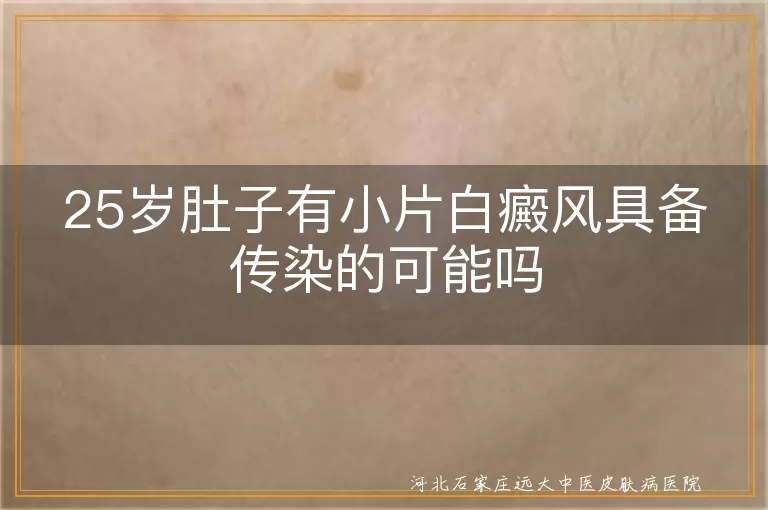 肚子白斑不会传染别慌,肚子小块白癜风日常细节,25岁白癜风传染性真相