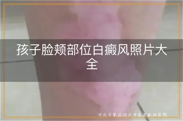 孩子脸颊部位白癜风照片大全