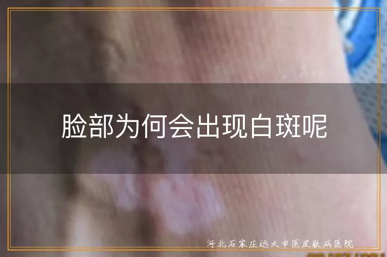 脸部为何会出现白斑呢