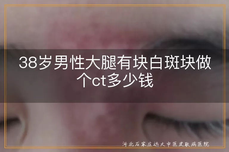 38岁男性大腿有块白斑块做个ct多少钱