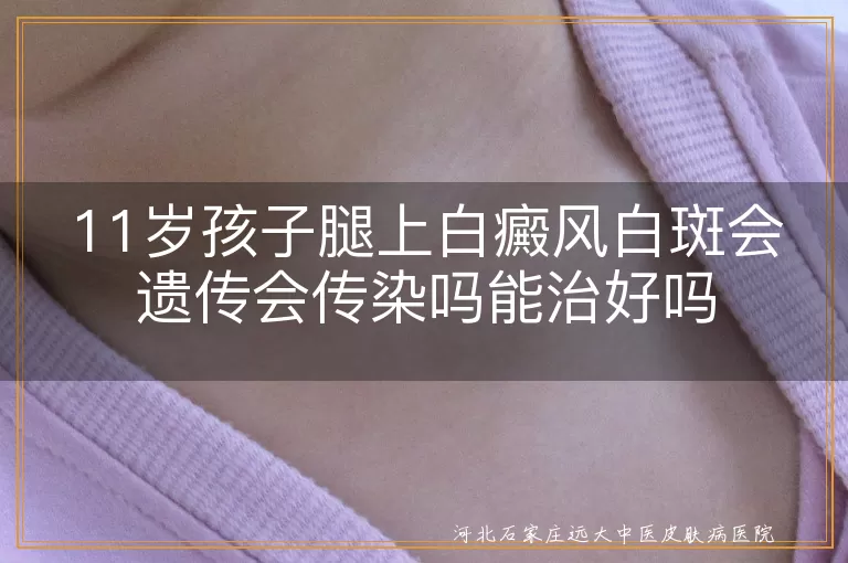 11岁孩子腿上白癜风白斑会遗传会传染吗能治好吗
