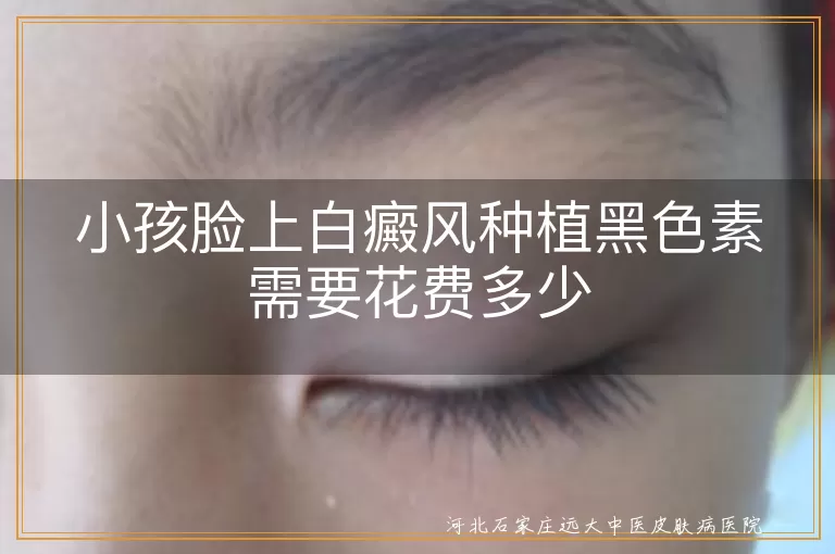 小孩脸上白癜风种植黑色素需要花费多少
