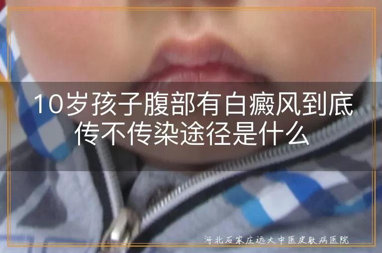 10岁孩子腹部有白癜风到底传不传染途径是什么