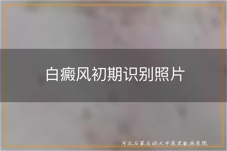 白癜风初期识别照片