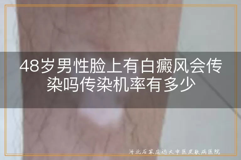 中年男性脸部白癜风,白斑传染几率,白癜风不具传染性