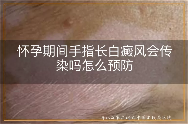 孕期手指白斑会传给胎儿吗,孕妈手白癜风传染风险应对,怀孕早期白斑预防全攻略
