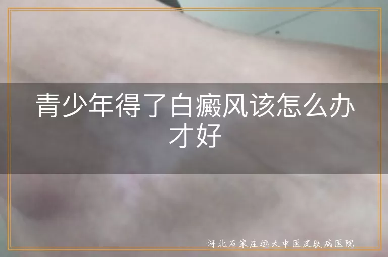 青少年白癜风心理疏导方案,白斑复学生活平衡技巧,青春期白癜风规范化管理