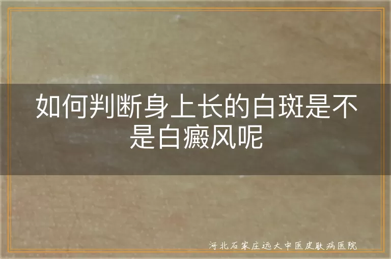 如何判断身上长的白斑是不是白癜风呢