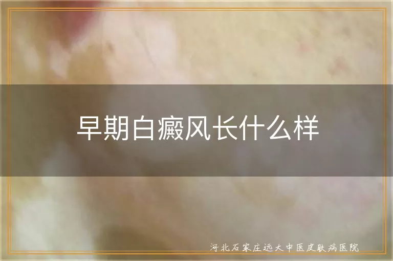 早期白癜风长什么样