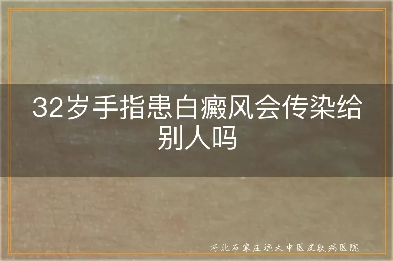32岁手指患白癜风会传染给别人吗