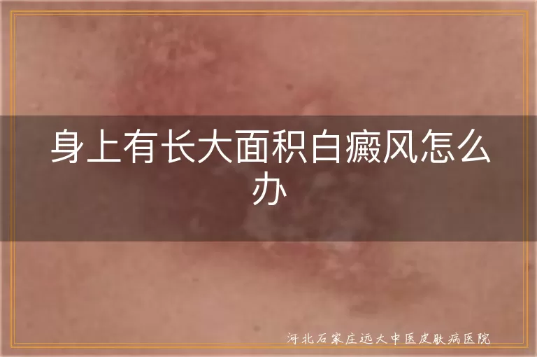 身上有长大面积白癜风怎么办