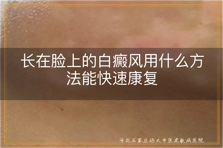 长在脸上的白癜风用什么方法能快速康复