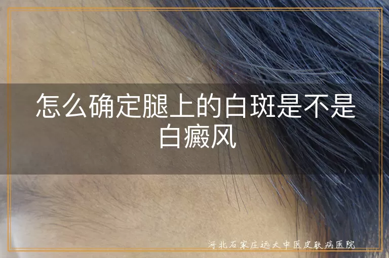怎么确定腿上的白斑是不是白癜风