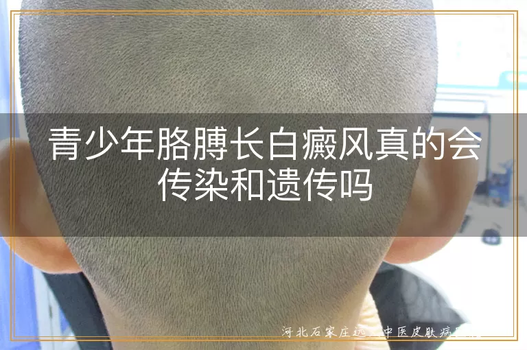 青少年胳膊长白癜风真的会传染和遗传吗