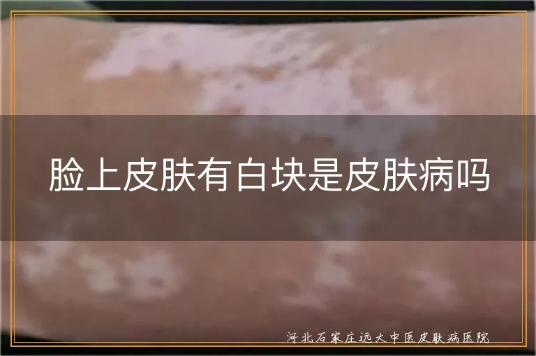 脸上皮肤有白块是皮肤病吗