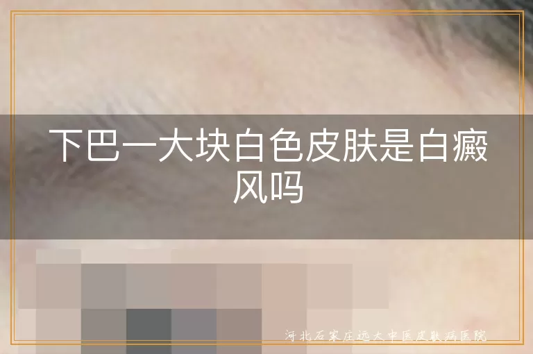 下巴一大块白色皮肤是白癜风吗