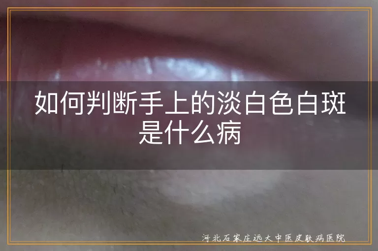 手上白斑如何辨别是不是白癜风,手掌淡白色斑块是否属于白斑病,手背淡白斑点是不是早期白癜风