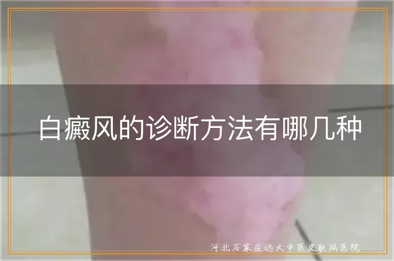 白癜风诊断技巧详解,白斑早筛早知道,白癜风科学辨别方式