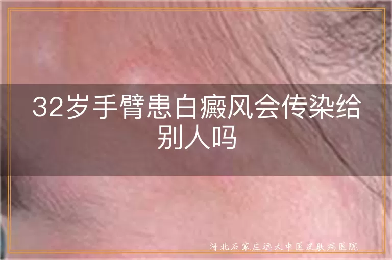 32岁手臂患白癜风会传染给别人吗