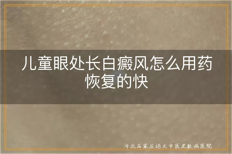 儿童眼周白斑治疗攻略,眼边白癜风用药技巧,宝宝面部白斑康复窍门