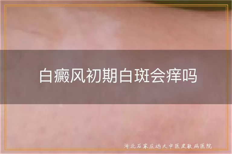 白癜风初期白斑会痒吗