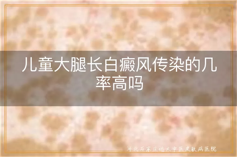 小孩腿白斑会传染家人吗,儿童大腿白癜风传播风险解析,幼儿白癜风白斑需要隔离吗