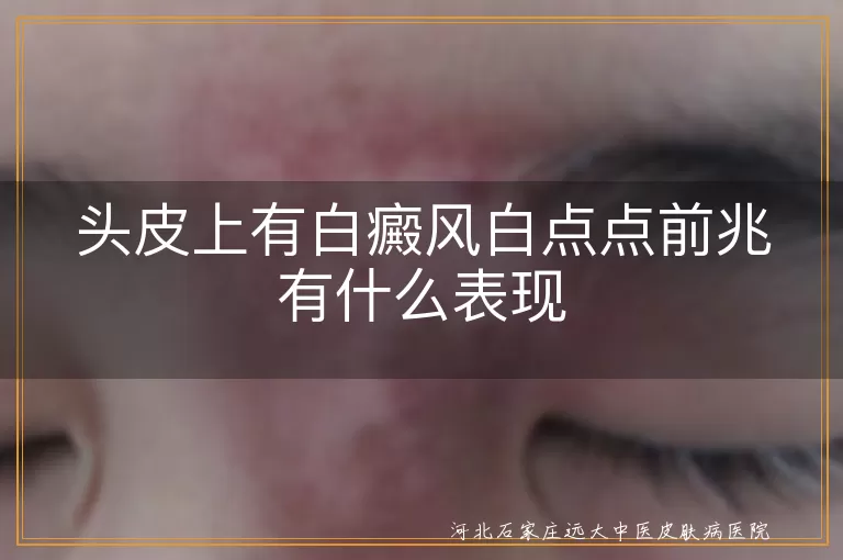 头皮白癜风早期表现,白癜风白斑初期迹象,头皮白斑隐匿症状