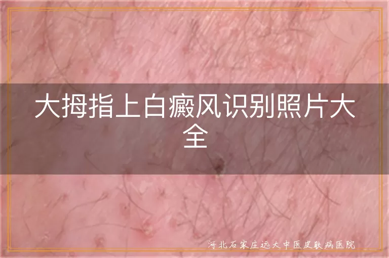 大拇指早期白斑自查图,拇指白癜风对照图集,白斑症状实拍与诊断