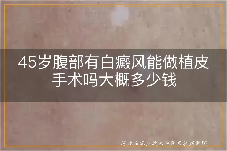 45岁腹部有白癜风能做植皮手术吗大概多少钱