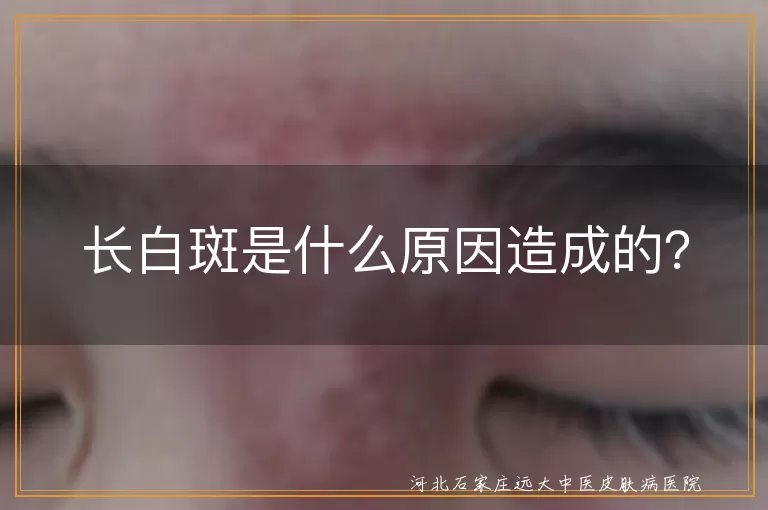 长白斑是什么原因造成的？
