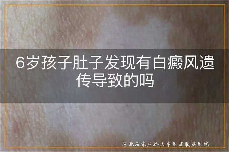 孩子肚子白斑遗传吗,儿童白癜风家族史,肚子白斑是否遗传